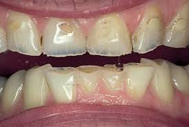 bulimia pérdida del esmalte dental